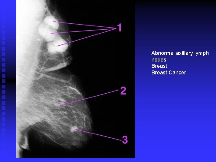 Abnormal axillary lymph nodes Breast Cancer 