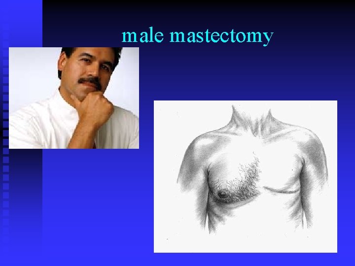 male mastectomy 