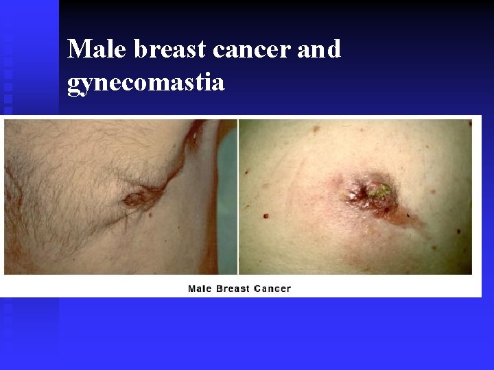 Male breast cancer and gynecomastia 