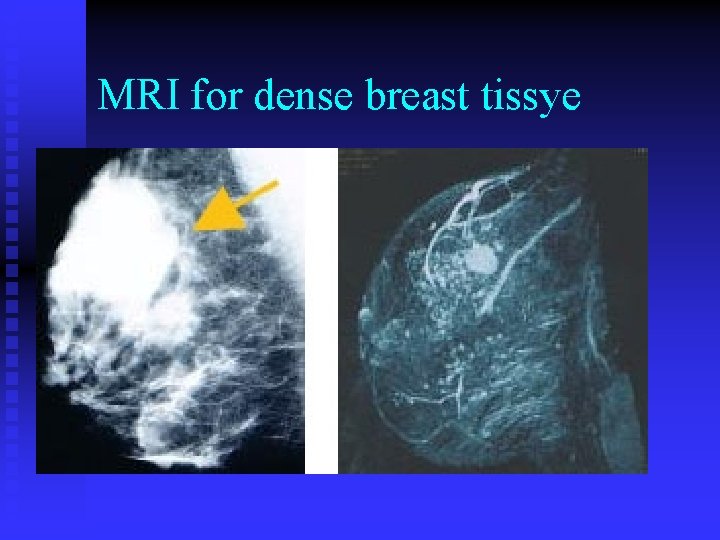 MRI for dense breast tissye 