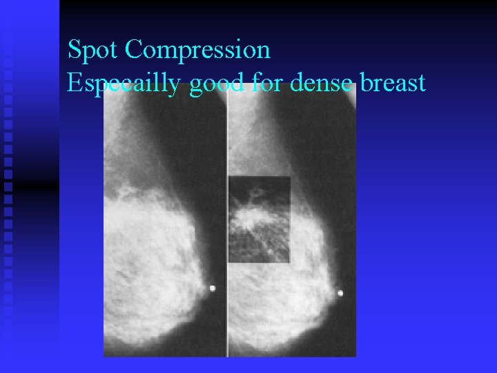 Spot Compression Especailly good for dense breast 