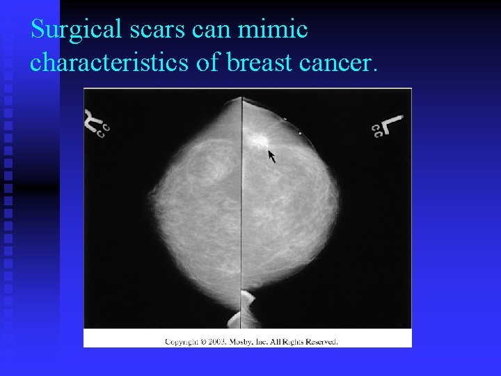 Surgical scars can mimic characteristics of breast cancer. 
