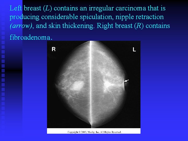 Left breast (L) contains an irregular carcinoma that is producing considerable spiculation, nipple retraction