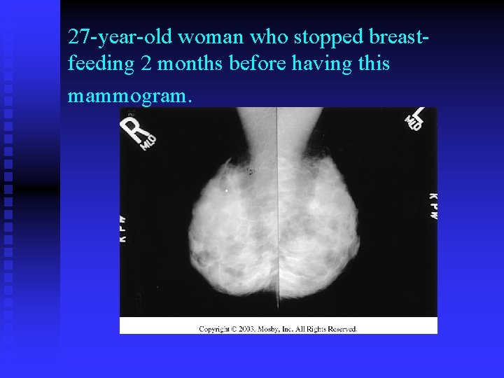 27 -year-old woman who stopped breastfeeding 2 months before having this mammogram. 