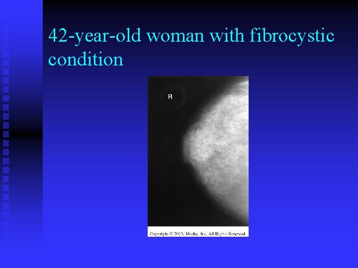 42 -year-old woman with fibrocystic condition 