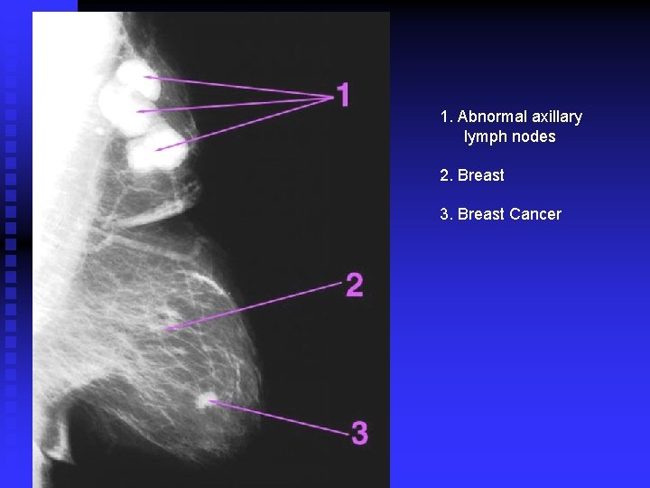 1. Abnormal axillary lymph nodes 2. Breast 3. Breast Cancer 