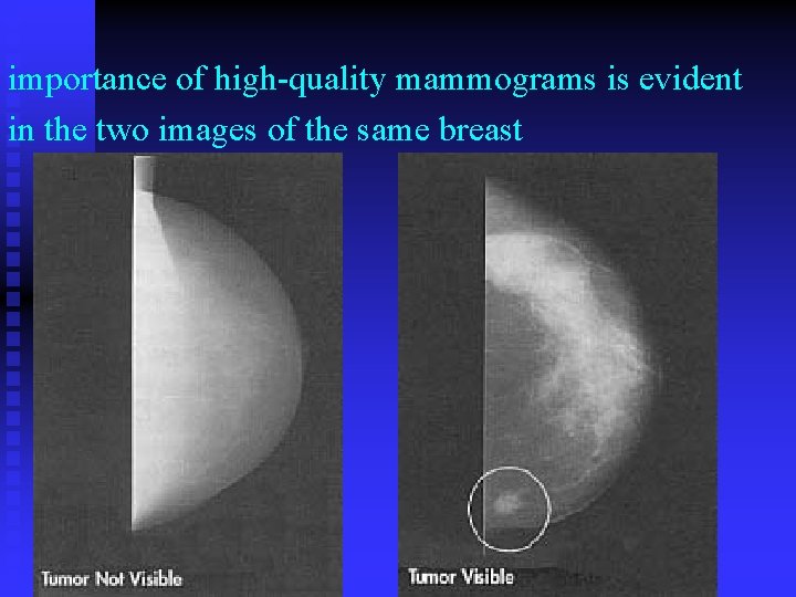 importance of high-quality mammograms is evident in the two images of the same breast