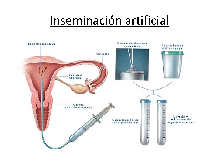 Inseminación artificial • La Inseminacion Artificial es un procedimiento de fertilización en el que