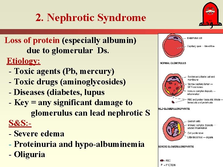 2. Nephrotic Syndrome Loss of protein (especially albumin) due to glomerular Ds. Etiology: -