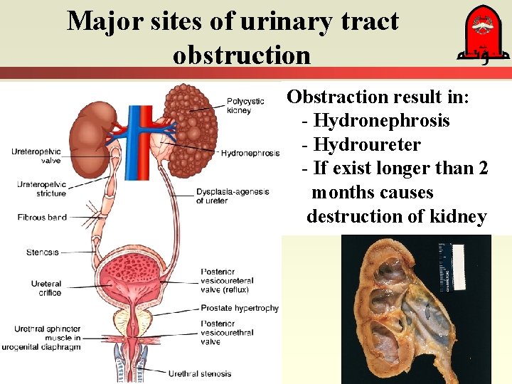 Major sites of urinary tract obstruction Obstraction result in: - Hydronephrosis - Hydroureter -