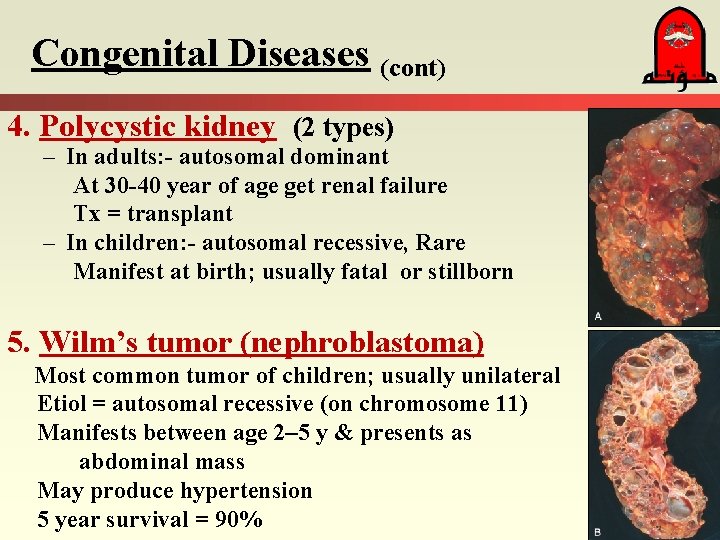 Congenital Diseases (cont) 4. Polycystic kidney (2 types) – In adults: - autosomal dominant