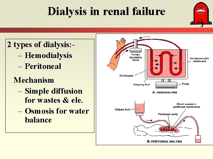 Dialysis in renal failure 2 types of dialysis: – Hemodialysis – Peritoneal Mechanism –