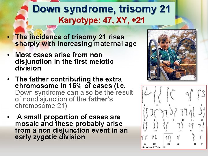 Down syndrome, trisomy 21 Karyotype: 47, XY, +21 • The incidence of trisomy 21