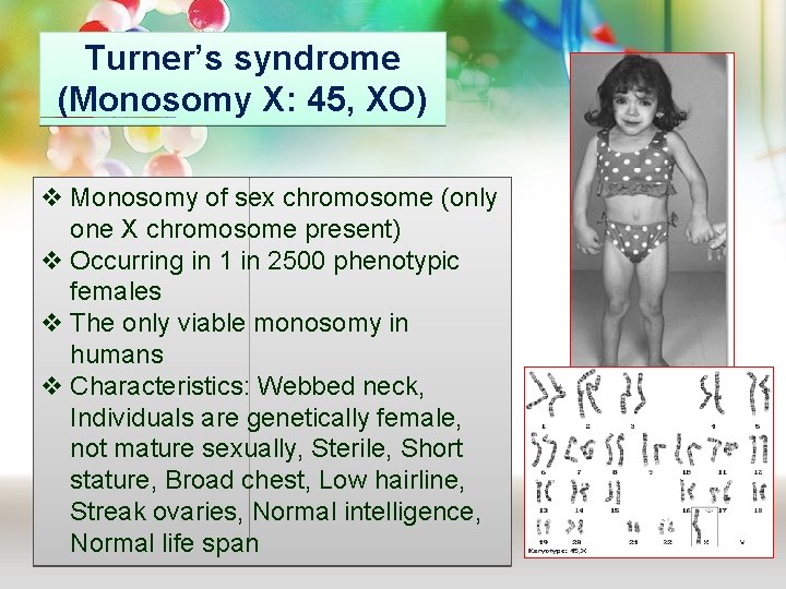 Turner’s syndrome (Monosomy X: 45, XO) v Monosomy of sex chromosome (only one X