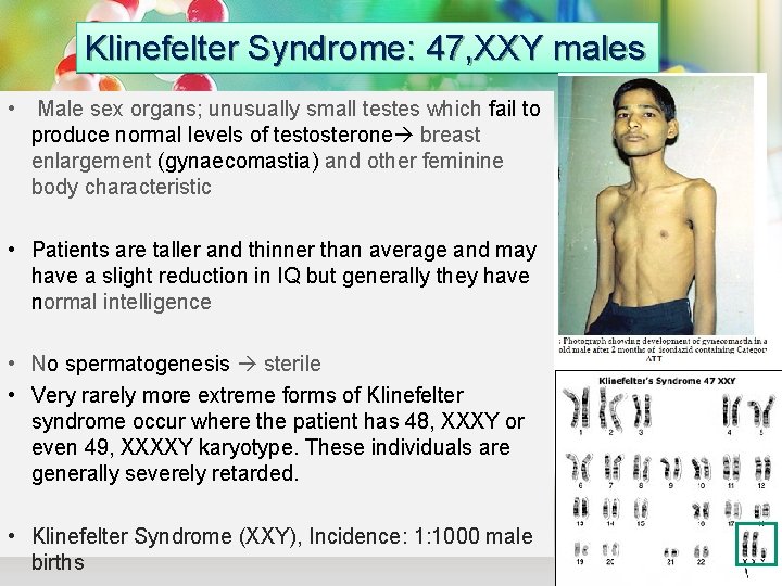 Klinefelter Syndrome: 47, XXY males • Male sex organs; unusually small testes which fail