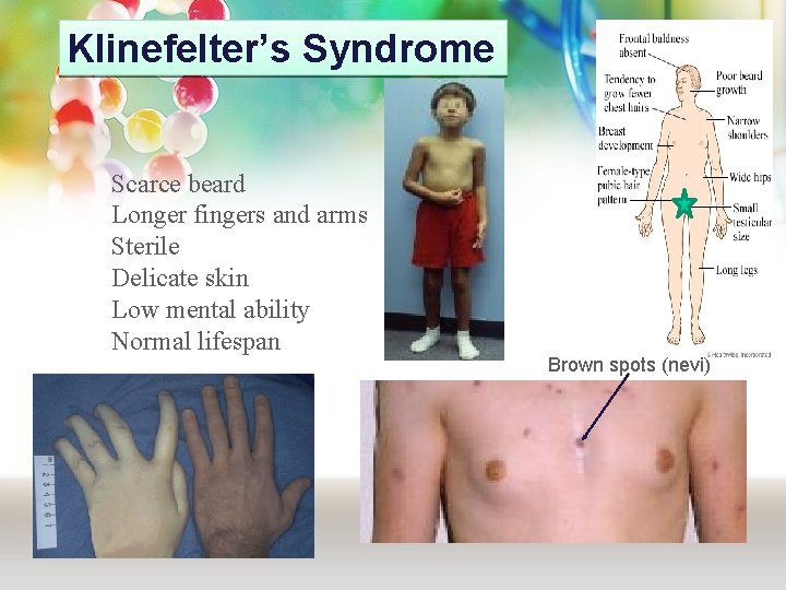 Klinefelter’s Syndrome Scarce beard Longer fingers and arms Sterile Delicate skin Low mental ability