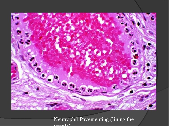 Neutrophil Pavementing (lining the 