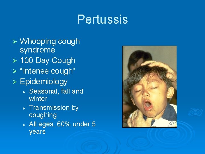 Pertussis Whooping cough syndrome Ø 100 Day Cough Ø “Intense cough” Ø Epidemiology Ø