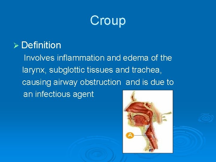 Croup Ø Definition Involves inflammation and edema of the larynx, subglottic tissues and trachea,