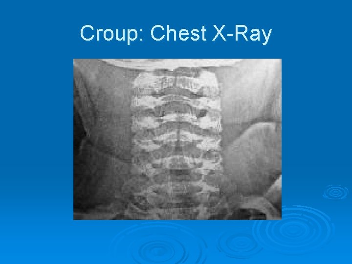 Croup: Chest X-Ray 