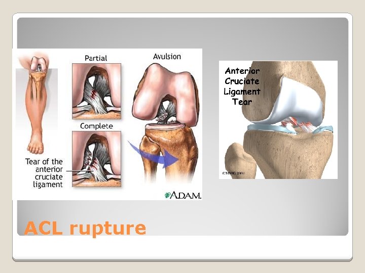 ACL rupture 