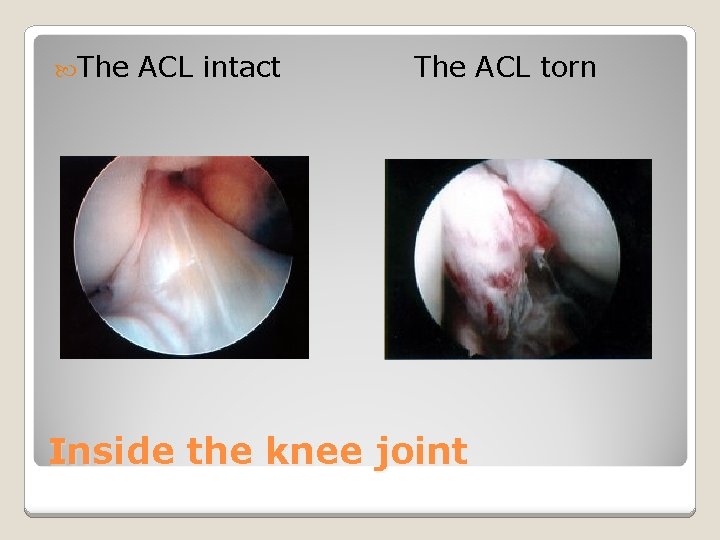  The ACL intact The ACL torn Inside the knee joint 