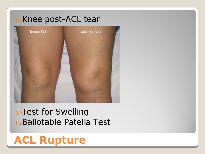  Knee post-ACL tear Test for Swelling Ballotable Patella Test ACL Rupture 