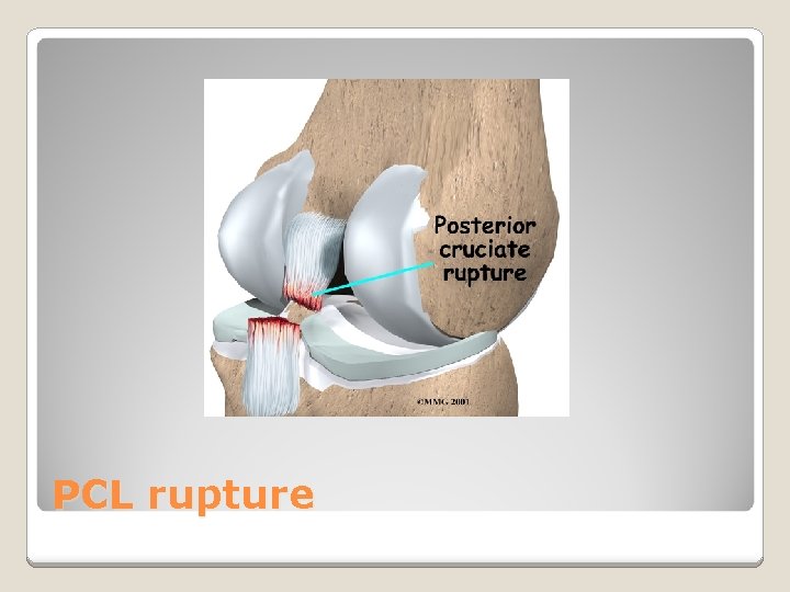 PCL rupture 