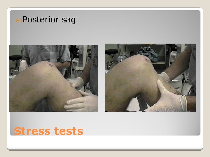  Posterior sag Stress tests 