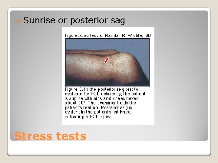  Sunrise or posterior sag Stress tests 