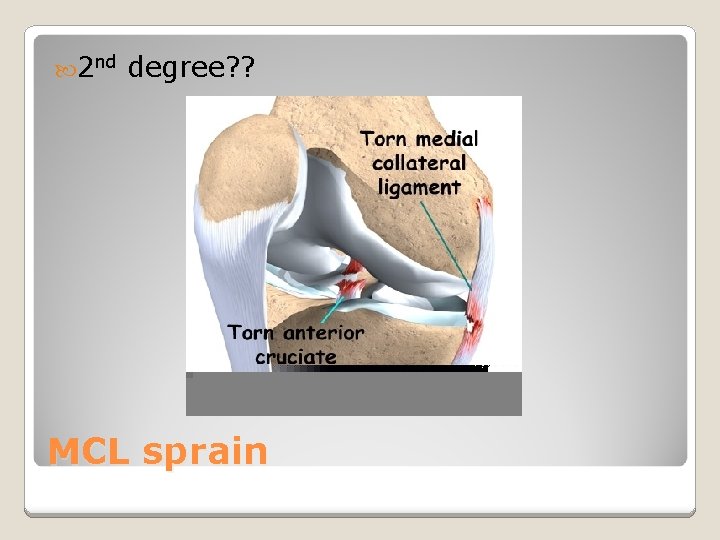  2 nd degree? ? MCL sprain 