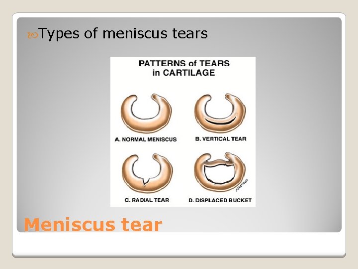  Types of meniscus tears Meniscus tear 