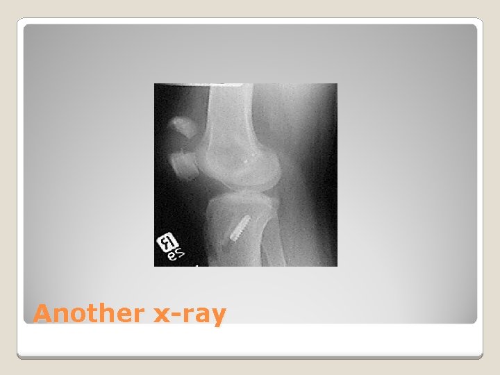 Another x-ray 