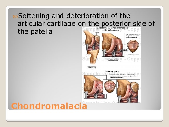  Softening and deterioration of the articular cartilage on the posterior side of the