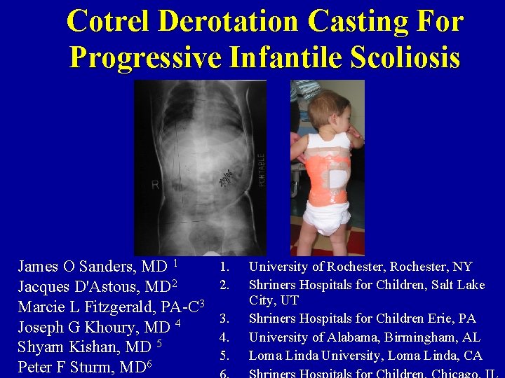 Cotrel Derotation Casting For Progressive Infantile Scoliosis James O Sanders, MD 1 Jacques D'Astous,
