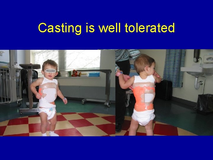 Casting is well tolerated 