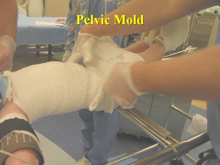 Pelvic Mold 