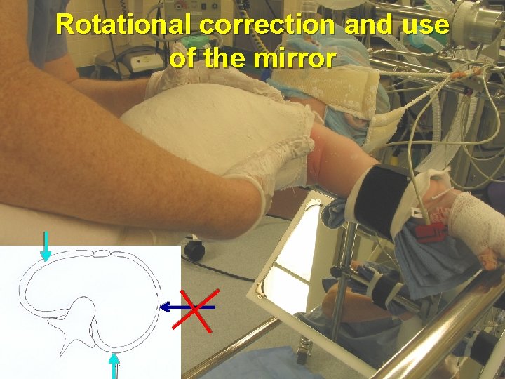 Rotational correction and use of the mirror 