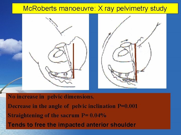 Mc. Roberts manoeuvre: X ray pelvimetry study No increase in pelvic dimensions. Decrease in
