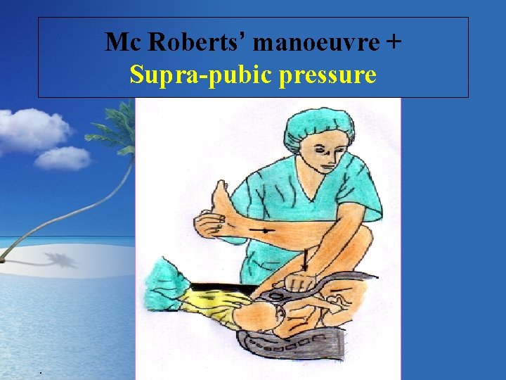 Mc Roberts’ manoeuvre + Supra-pubic pressure . 