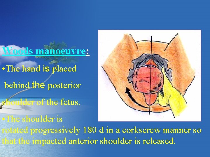 Woods manoeuvre: • The hand is placed behind the posterior shoulder of the fetus.