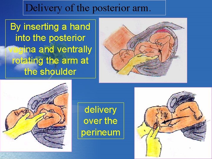 Delivery of the posterior arm. By inserting a hand into the posterior vagina and