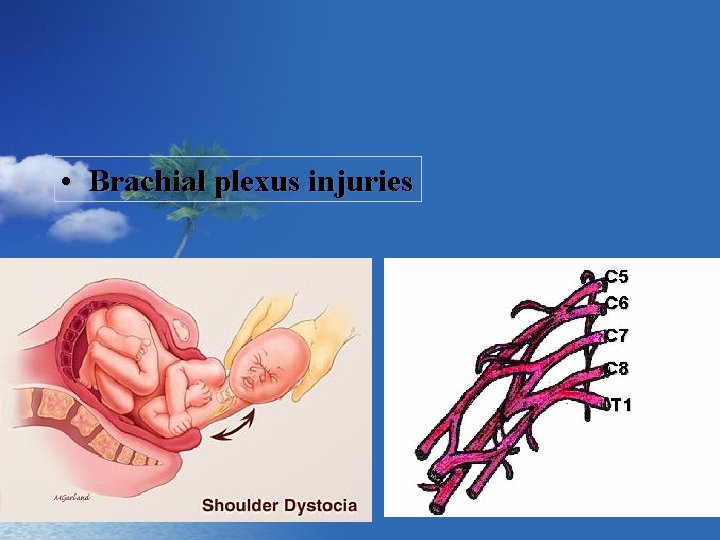  • Brachial plexus injuries 