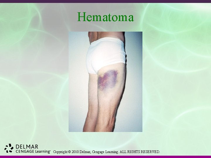 Hematoma Copyright © 2010 Delmar, Cengage Learning. ALL RIGHTS RESERVED. 