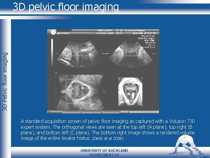 3 D Pelvic floor imaging 3 D pelvic floor imaging A standard acquisition screen