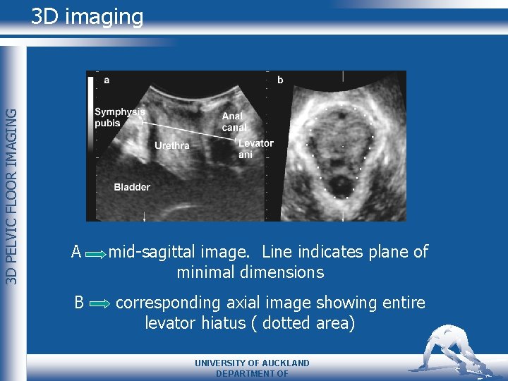 3 D PELVIC FLOOR IMAGING 3 D imaging A mid-sagittal image. Line indicates plane