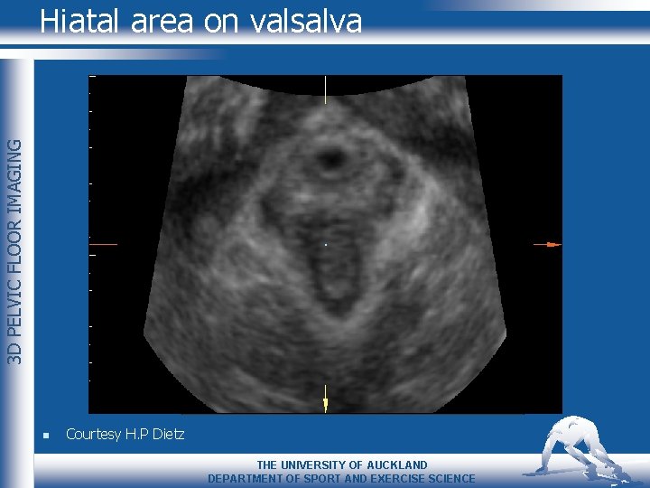 3 D PELVIC FLOOR IMAGING Hiatal area on valsalva n Courtesy H. P Dietz