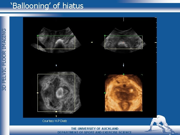 3 D PELVIC FLOOR IMAGING ‘Ballooning’ of hiatus Courtesy H. P Dietz THE UNIVERSITY