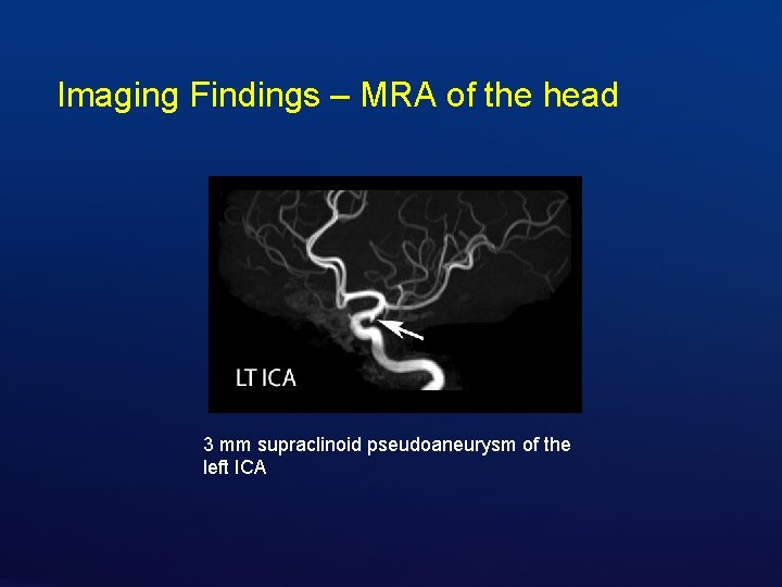 Imaging Findings – MRA of the head 3 mm supraclinoid pseudoaneurysm of the left