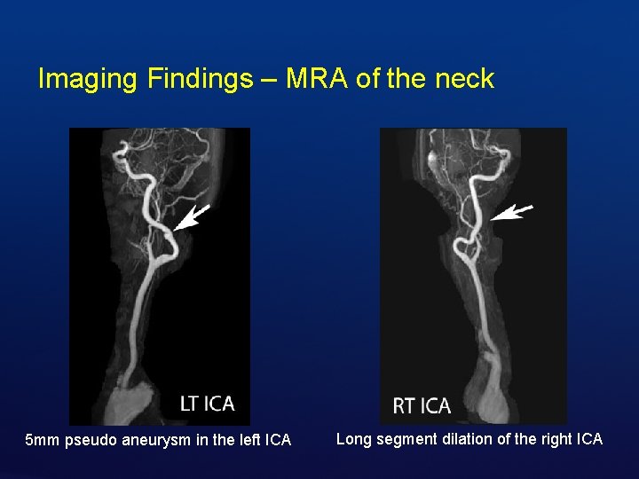 Imaging Findings – MRA of the neck 5 mm pseudo aneurysm in the left
